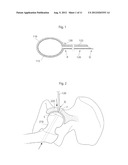 APPARATUS AND METHODS FOR TREATMENT OF ARTHROSIS OR OSTEOARTHRITIS IN A     JOINT OF A MAMMAL OR HUMAN PATIENT diagram and image