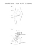 APPARATUS AND METHODS FOR TREATMENT OF ARTHROSIS OR OSTEOARTHRITIS IN A     JOINT OF A MAMMAL OR HUMAN PATIENT diagram and image