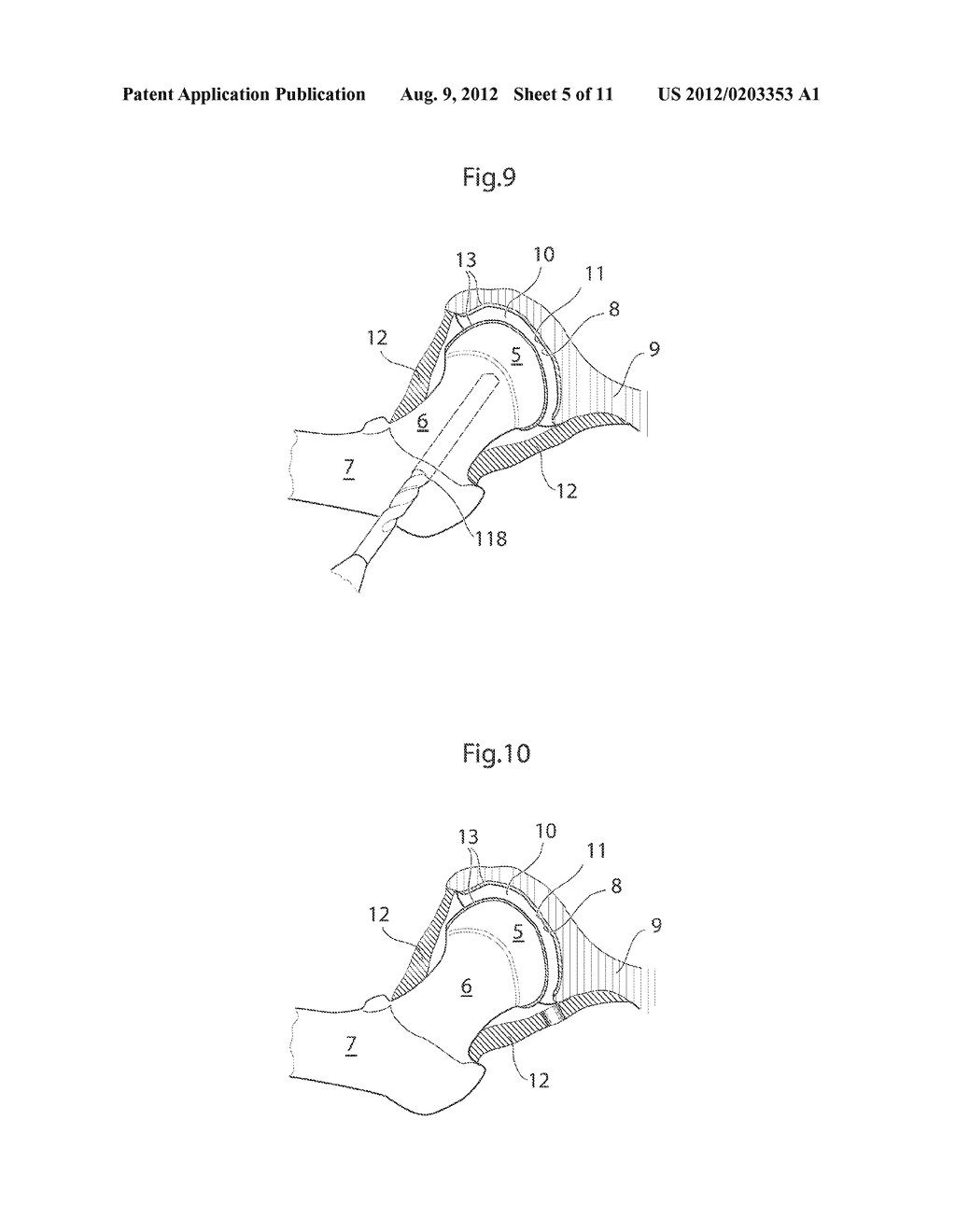 APPARATUS AND METHODS FOR TREATMENT OF ARTHROSIS OR OSTEOARTHRITIS IN A     JOINT OF A MAMMAL OR HUMAN PATIENT - diagram, schematic, and image 07