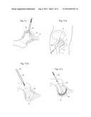 APPARATUS AND METHODS FOR TREATMENT OF ARTHROSIS OR OSTEOARTHRITIS IN A     JOINT OF A MAMMAL OR HUMAN PATIENT diagram and image