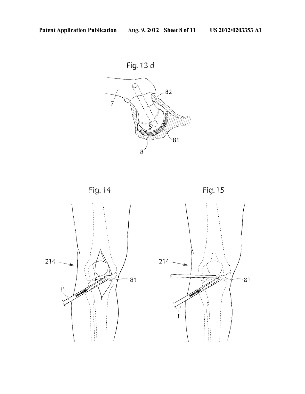 APPARATUS AND METHODS FOR TREATMENT OF ARTHROSIS OR OSTEOARTHRITIS IN A     JOINT OF A MAMMAL OR HUMAN PATIENT - diagram, schematic, and image 10