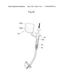 APPARATUS AND METHODS FOR TREATMENT OF ARTHROSIS OR OSTEOARTHRITIS IN A     JOINT OF A MAMMAL OR HUMAN PATIENT diagram and image