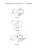 TONGUE RETENTION SYSTEM diagram and image