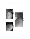 METHODS AND PHARMACEUTICAL COMPOSITIONS USEFUL FOR TREATING PSORIASIS diagram and image