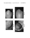 METHODS AND PHARMACEUTICAL COMPOSITIONS USEFUL FOR TREATING PSORIASIS diagram and image