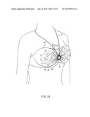 BREAST HEALTH CARE DEVICE diagram and image