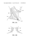 CERVICAL COLLAR WITH REDUCED VASCULAR OBSTRUCTION diagram and image