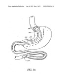 Methods of replacing a gastrointestinal bypass sleeve for therapy     adjustment diagram and image