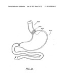 Methods of replacing a gastrointestinal bypass sleeve for therapy     adjustment diagram and image