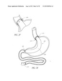 Methods of replacing a gastrointestinal bypass sleeve for therapy     adjustment diagram and image