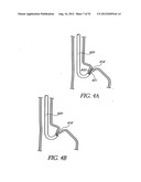 Methods of replacing a gastrointestinal bypass sleeve for therapy     adjustment diagram and image