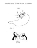 Methods of replacing a gastrointestinal bypass sleeve for therapy     adjustment diagram and image