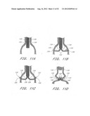 Methods of replacing a gastrointestinal bypass sleeve for therapy     adjustment diagram and image