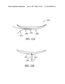 Methods of replacing a gastrointestinal bypass sleeve for therapy     adjustment diagram and image