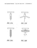 Methods of replacing a gastrointestinal bypass sleeve for therapy     adjustment diagram and image