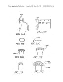 Methods of replacing a gastrointestinal bypass sleeve for therapy     adjustment diagram and image