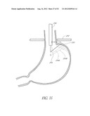 Methods of replacing a gastrointestinal bypass sleeve for therapy     adjustment diagram and image