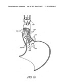 Methods of replacing a gastrointestinal bypass sleeve for therapy     adjustment diagram and image