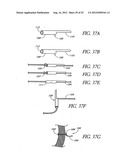 Methods of replacing a gastrointestinal bypass sleeve for therapy     adjustment diagram and image