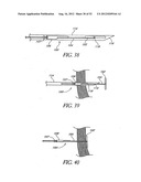 Methods of replacing a gastrointestinal bypass sleeve for therapy     adjustment diagram and image