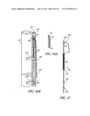 Methods of replacing a gastrointestinal bypass sleeve for therapy     adjustment diagram and image