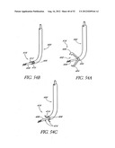 Methods of replacing a gastrointestinal bypass sleeve for therapy     adjustment diagram and image