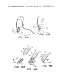 Methods of replacing a gastrointestinal bypass sleeve for therapy     adjustment diagram and image