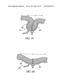 Methods of replacing a gastrointestinal bypass sleeve for therapy     adjustment diagram and image