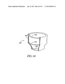 Methods of replacing a gastrointestinal bypass sleeve for therapy     adjustment diagram and image