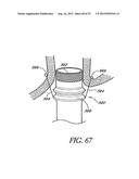 Methods of replacing a gastrointestinal bypass sleeve for therapy     adjustment diagram and image