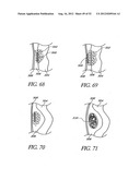 Methods of replacing a gastrointestinal bypass sleeve for therapy     adjustment diagram and image