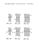 Methods of replacing a gastrointestinal bypass sleeve for therapy     adjustment diagram and image