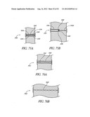 Methods of replacing a gastrointestinal bypass sleeve for therapy     adjustment diagram and image