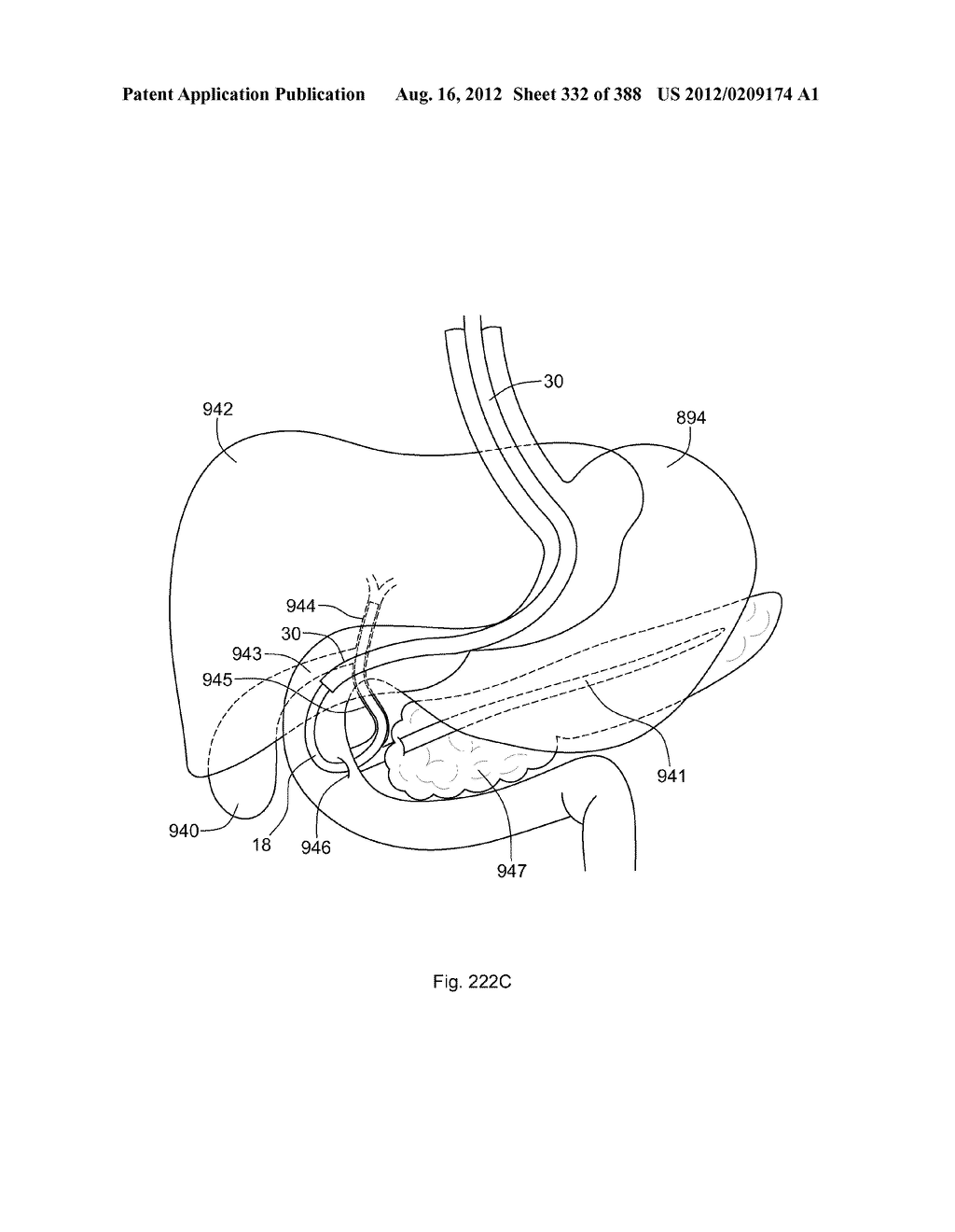 Robotic catheter system and methods - diagram, schematic, and image 333