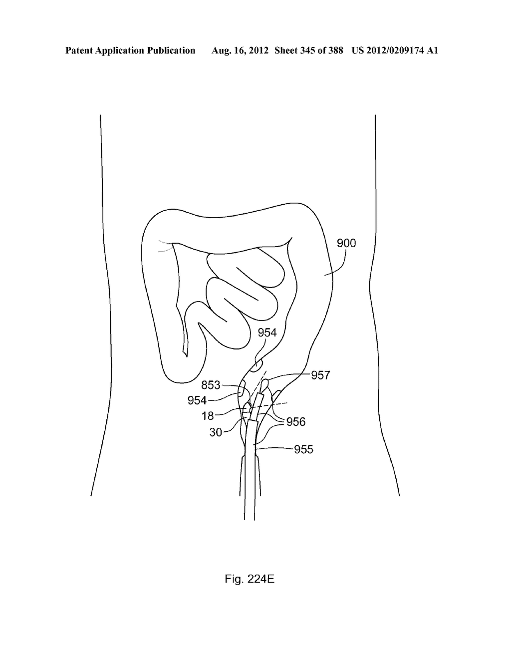 Robotic catheter system and methods - diagram, schematic, and image 346