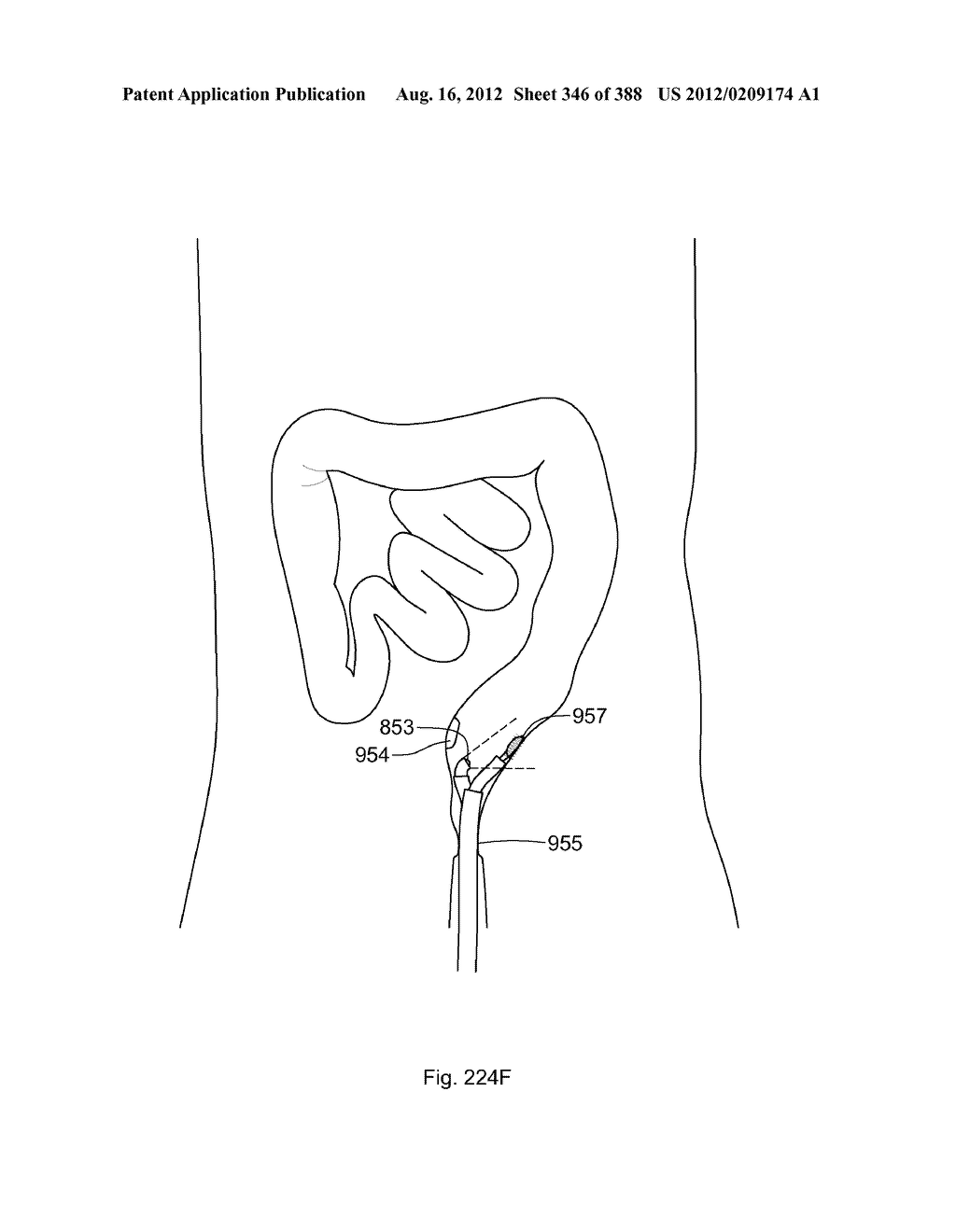 Robotic catheter system and methods - diagram, schematic, and image 347