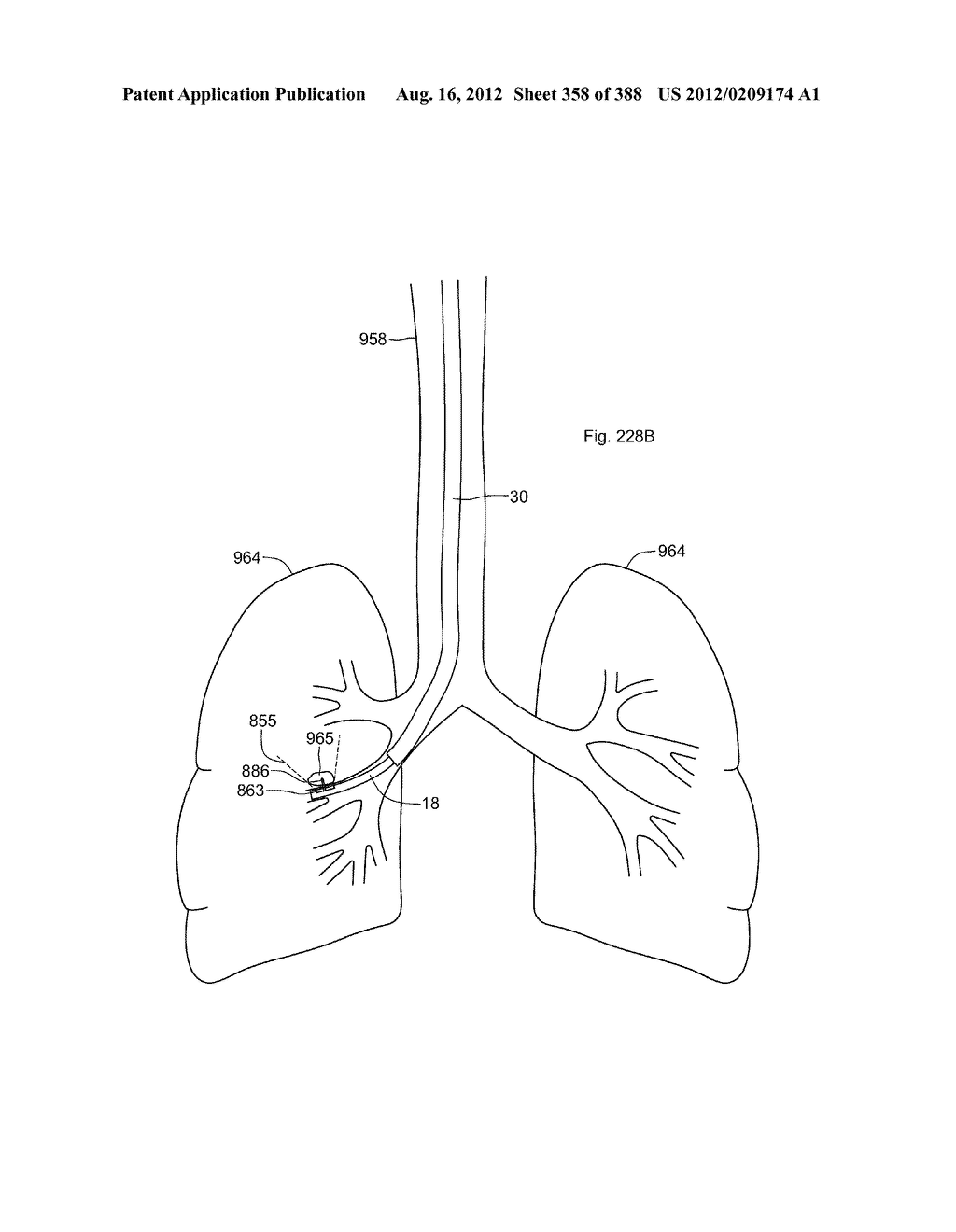 Robotic catheter system and methods - diagram, schematic, and image 359