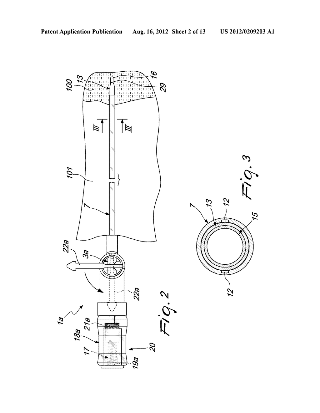 MEDICAL DEVICE FOR APPLYING CATHETERS, PARTICULARLY FOR THORACENTESIS     PROCEDURES - diagram, schematic, and image 03