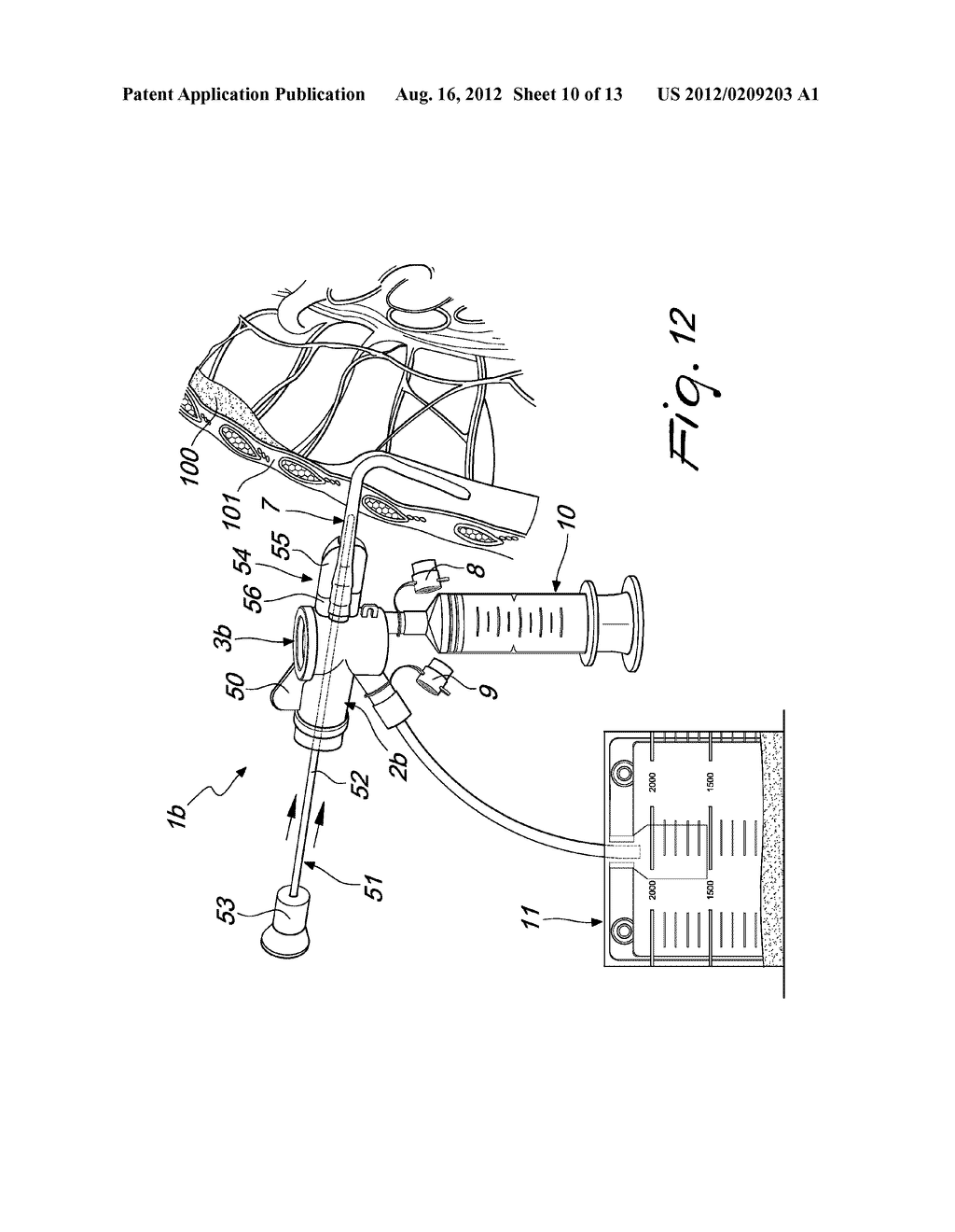 MEDICAL DEVICE FOR APPLYING CATHETERS, PARTICULARLY FOR THORACENTESIS     PROCEDURES - diagram, schematic, and image 11