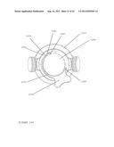 TROCAR STABILITY ASSEMBLY diagram and image