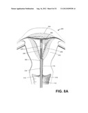 SYSTEMS AND METHODS FOR ENDOMETRIAL ABLATION diagram and image