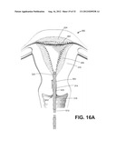 SYSTEMS AND METHODS FOR ENDOMETRIAL ABLATION diagram and image