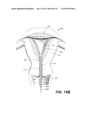 SYSTEMS AND METHODS FOR ENDOMETRIAL ABLATION diagram and image