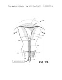 SYSTEMS AND METHODS FOR ENDOMETRIAL ABLATION diagram and image