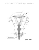 SYSTEMS AND METHODS FOR ENDOMETRIAL ABLATION diagram and image