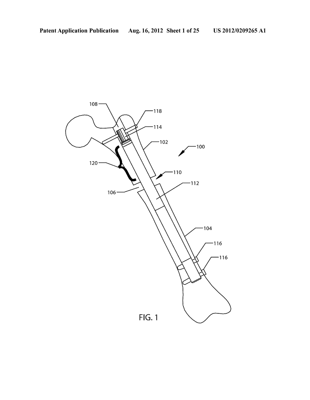 SYSTEM AND METHOD FOR ALTERING ROTATIONAL ALIGNMENT OF BONE SECTIONS - diagram, schematic, and image 02