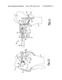 METHOD AND APPARATUS FOR PERFORMING KNEE ARTHROPLASTY diagram and image