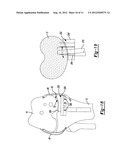 METHOD AND APPARATUS FOR PERFORMING KNEE ARTHROPLASTY diagram and image