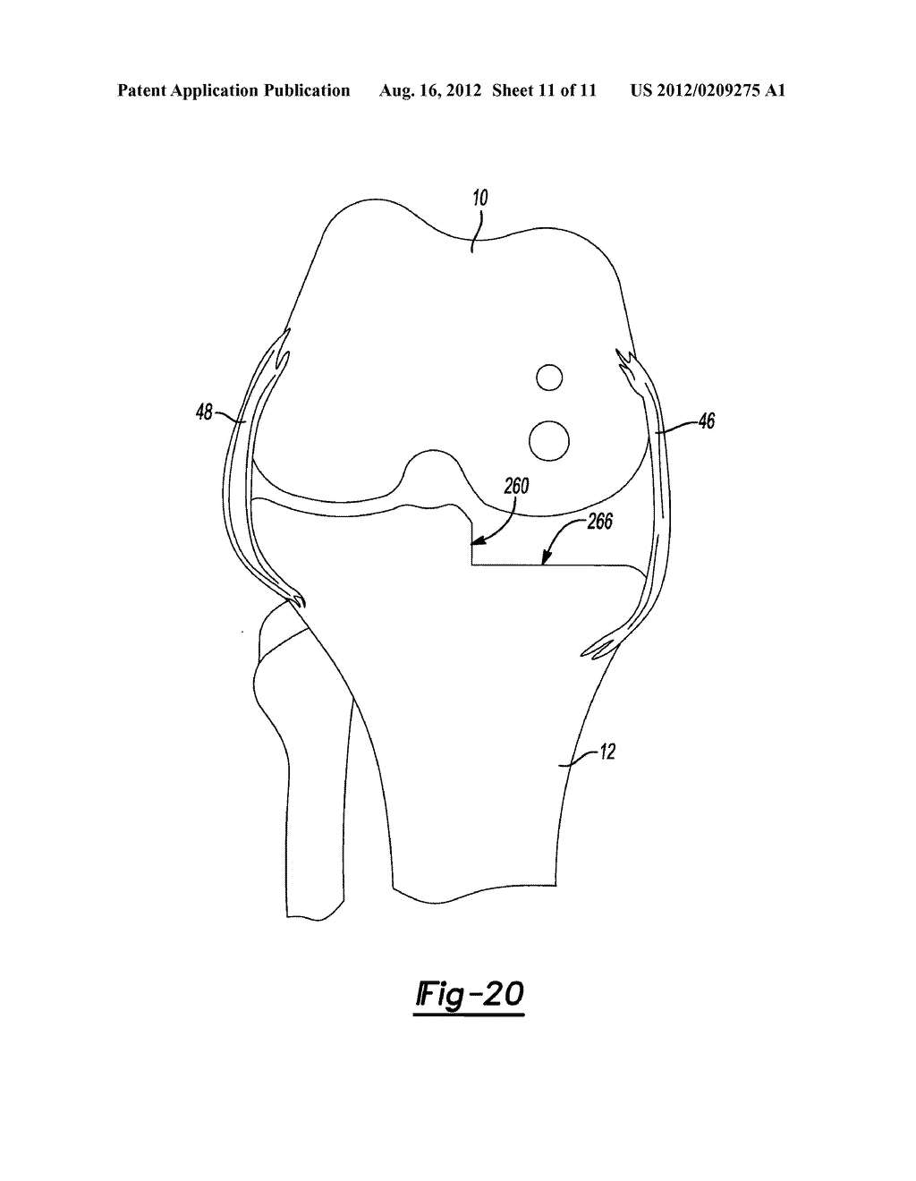 METHOD AND APPARATUS FOR PERFORMING KNEE ARTHROPLASTY - diagram, schematic, and image 12