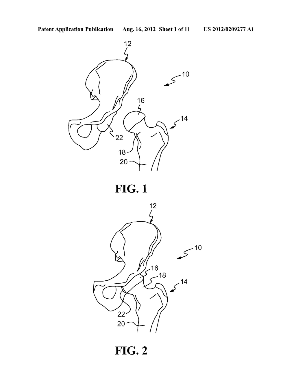 Depth of Impaction - diagram, schematic, and image 02